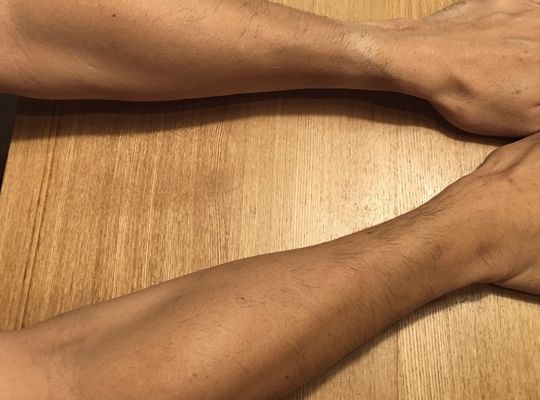 １回施術後の腕